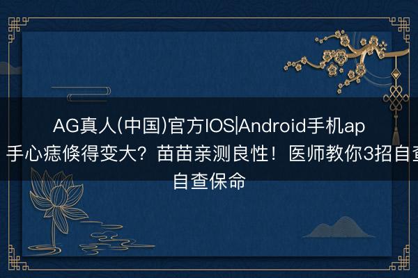 AG真人(中国)官方IOS|Android手机app下载 手心痣倏得变大？苗苗亲测良性！医师教你3招自查保命